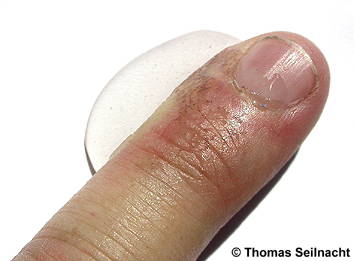 Silbernitrat-Lösung auf Finger